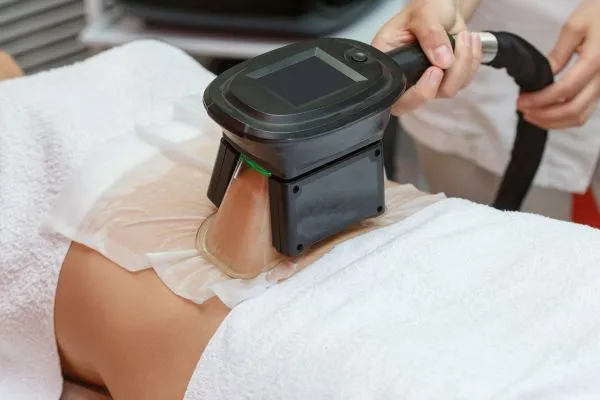 Image of person having fat freezing treatment to help weight gain Birkdale