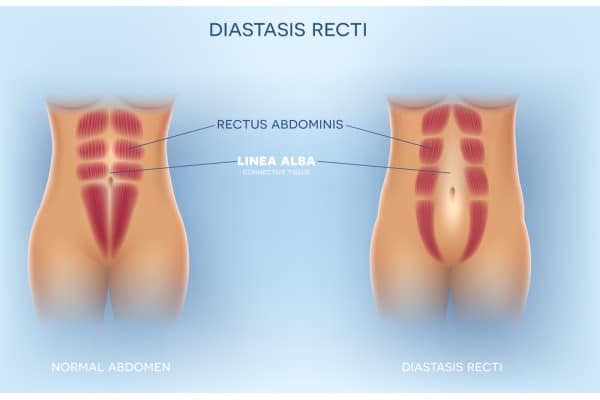 What Non-Surgical Options Are Available for Diastasis Recti Birkdale?