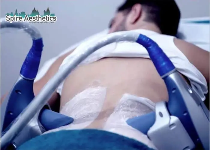 Man having fat freezing treatment done on love handles before a competitions Birkdale to create a sculpted look.