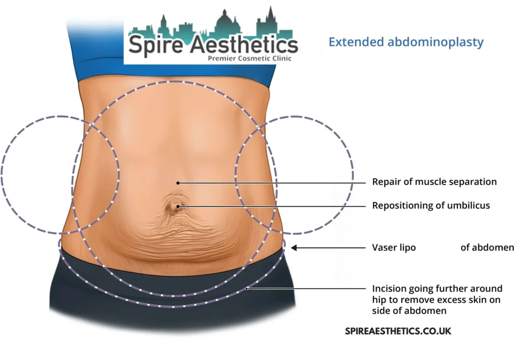Understanding Loose Skin After Gastric Band Birkdale Surgery and HIFU Treatment