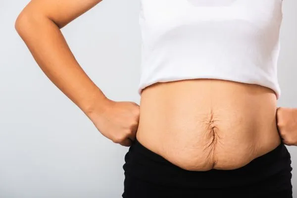 Image of a woman's stomach after weight loss with sagging skin following a gastric band Birkdale
