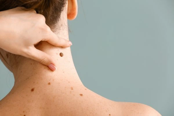 skin blemish removal Birkdale treatment
